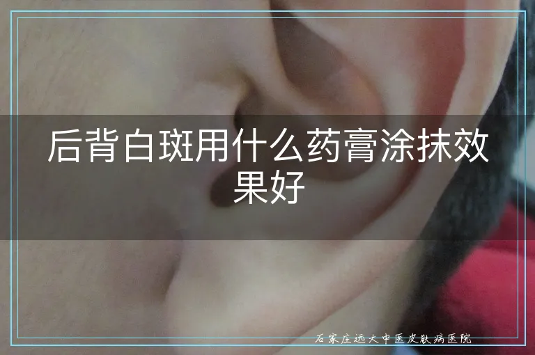 后背白斑用什么药膏涂抹效果好