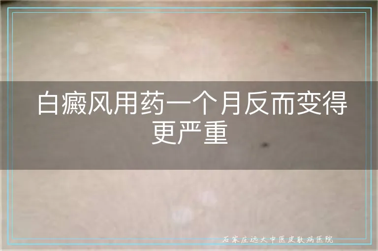 白癜风用药一个月反而变得更严重