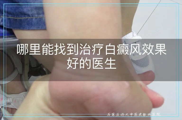 哪里能找到治疗白癜风效果好的医生