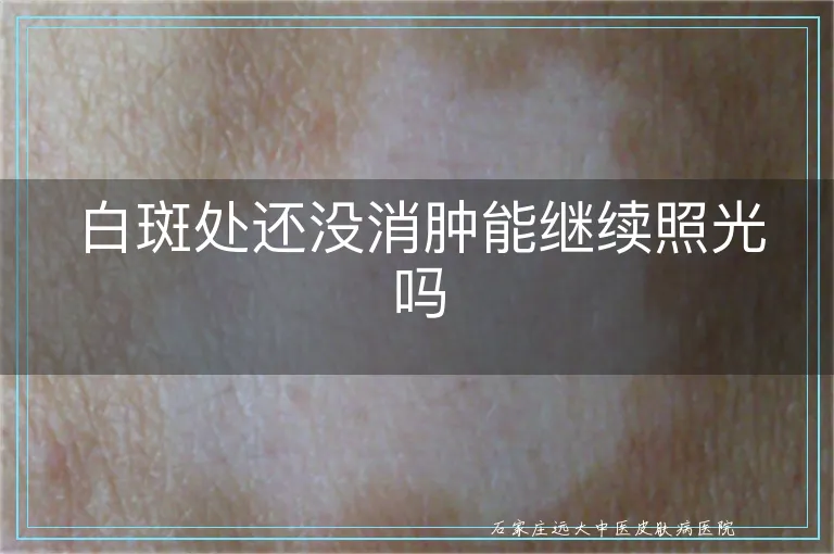 白斑处还没消肿能继续照光吗