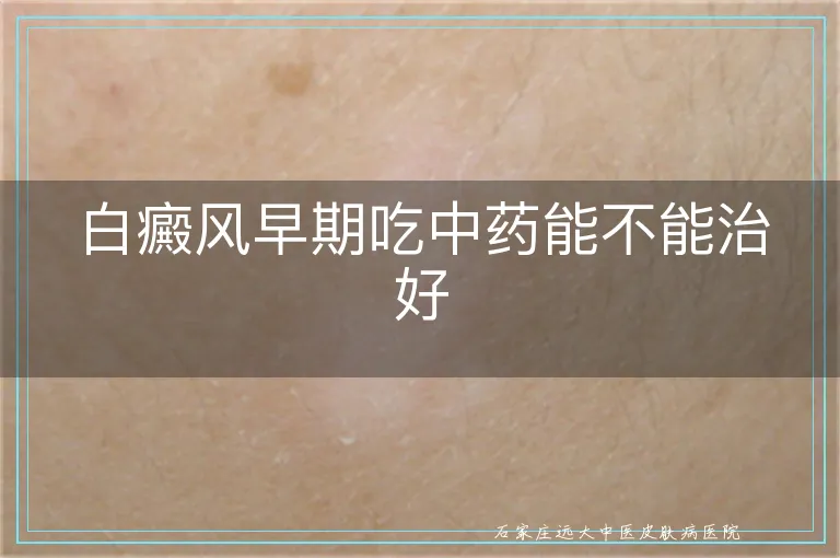 白癜风早期吃中药能不能治好
