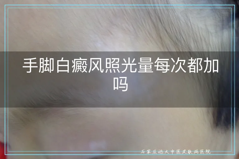 手脚白癜风照光量每次都加吗