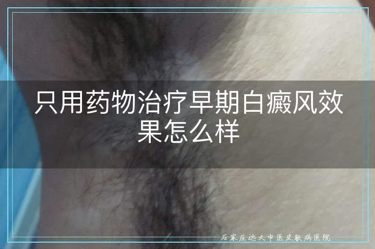只用药物治疗早期白癜风效果怎么样