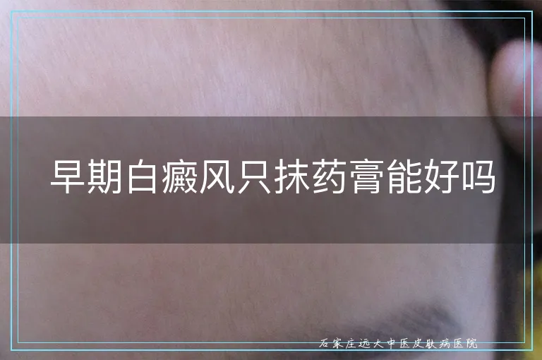 早期白癜风只抹药膏能好吗