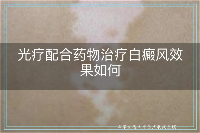 光疗配合药物治疗白癜风效果如何