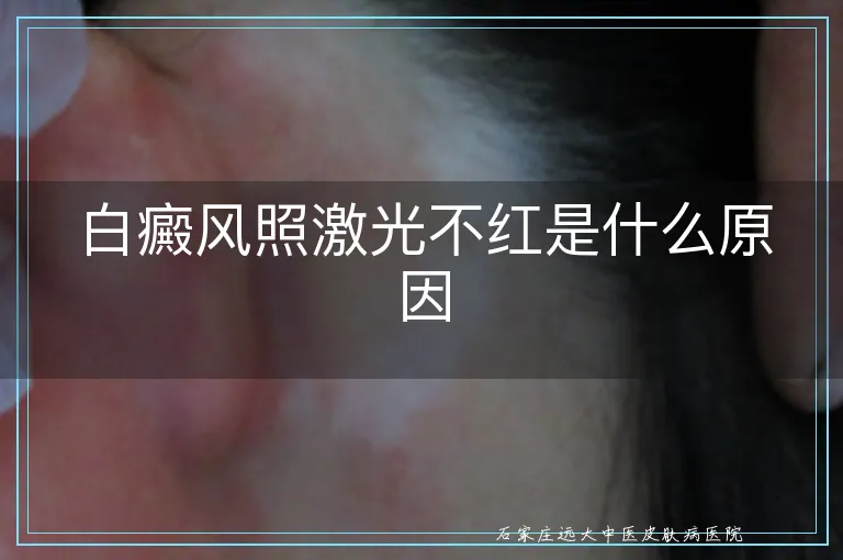 白癜风照激光不红是什么原因
