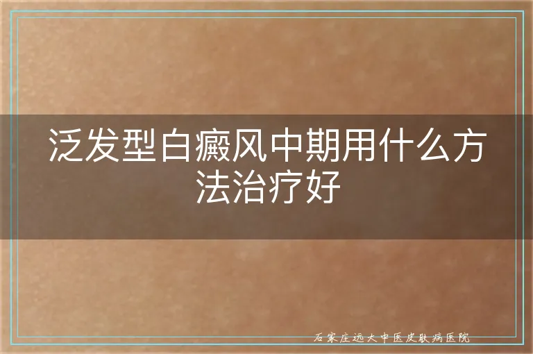 泛发型白癜风中期用什么方法治疗好