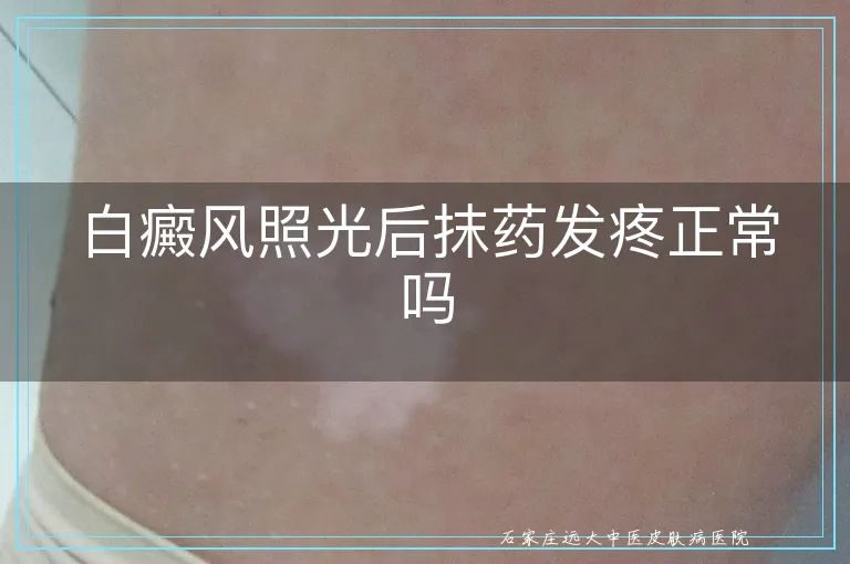 白癜风照光后抹药发疼正常吗