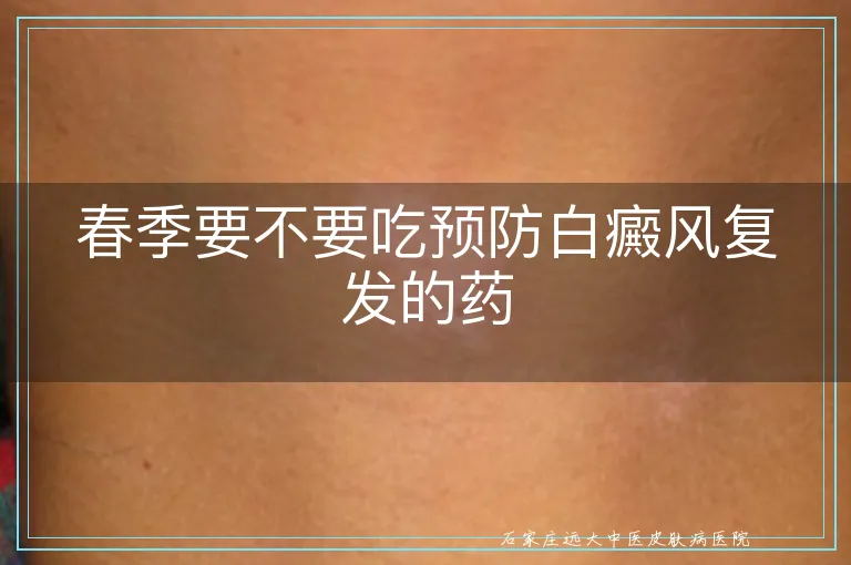 春季要不要吃预防白癜风复发的药