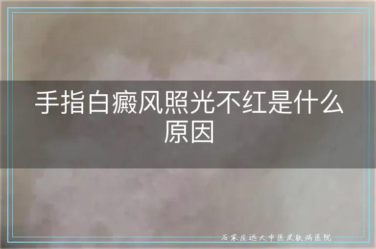 手指白癜风照光不红是什么原因
