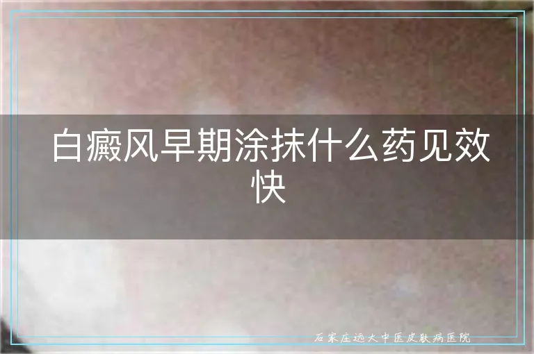 白癜风早期涂抹什么药见效快