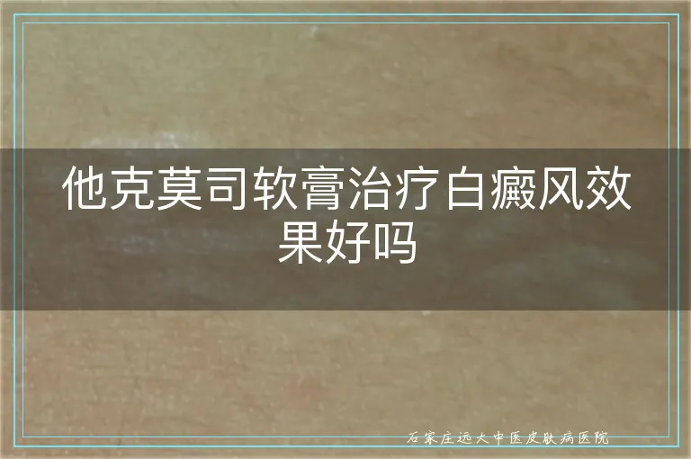 他克莫司软膏治疗白癜风效果好吗