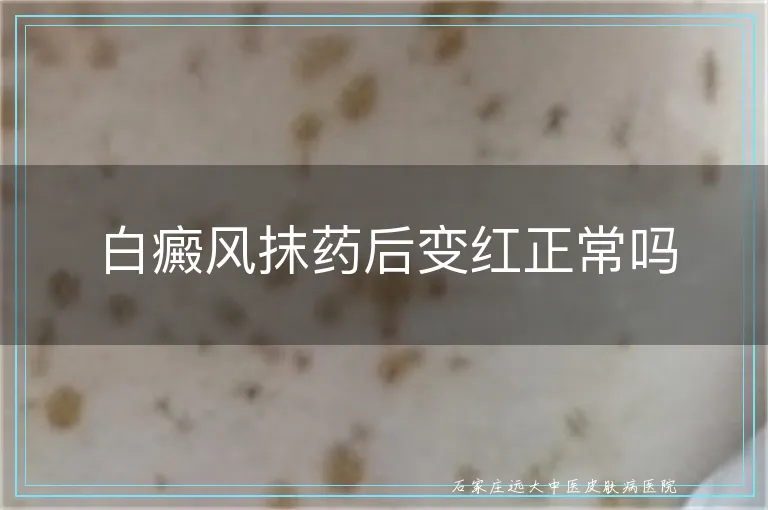 白癜风抹药后变红正常吗