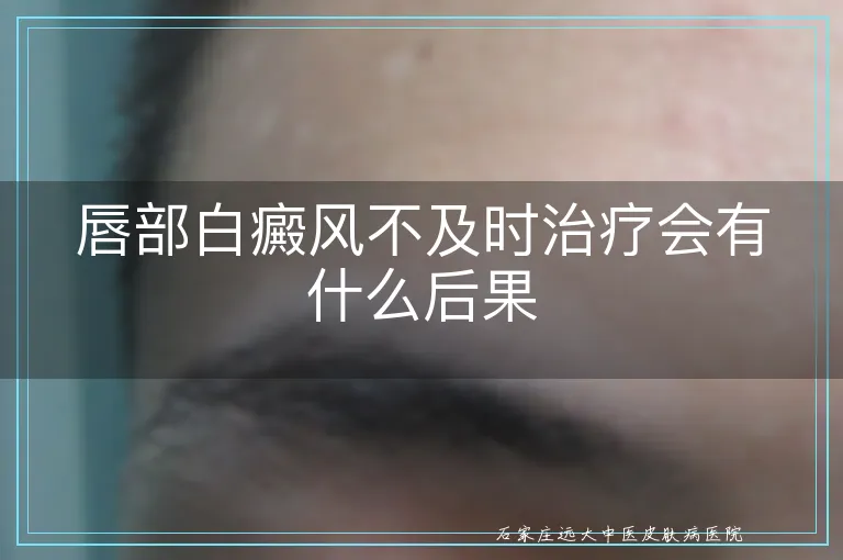 唇部白癜风不及时治疗会有什么后果