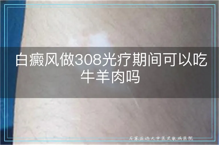 白癜风做308光疗期间可以吃牛羊肉吗