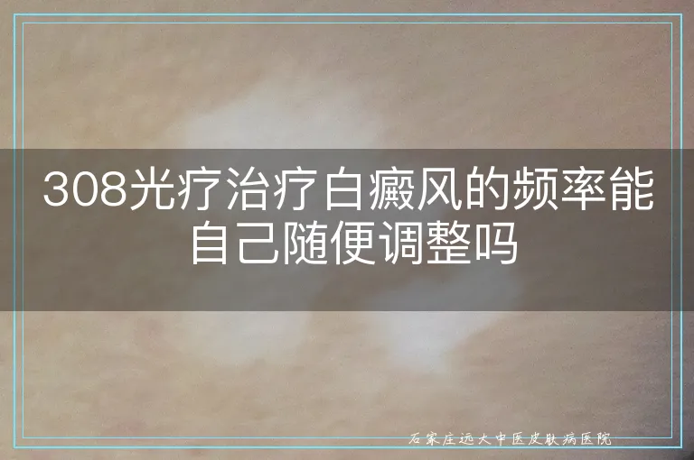 308光疗治疗白癜风的频率能自己随便调整吗