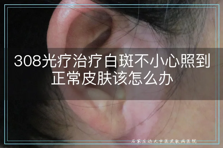 308光疗治疗白斑不小心照到正常皮肤该怎么办