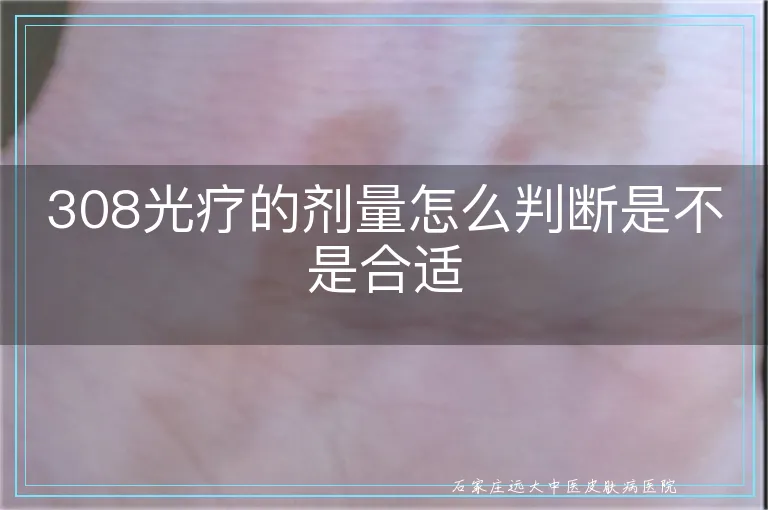 308光疗的剂量怎么判断是不是合适