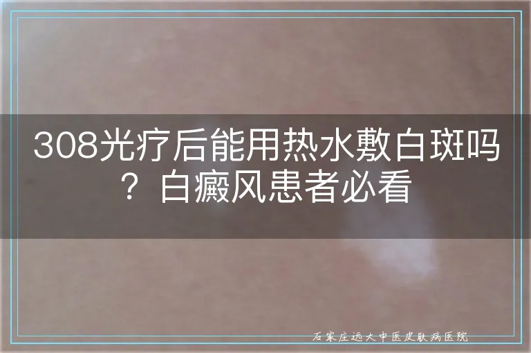 308光疗后能用热水敷白斑吗?白癜风患者必看