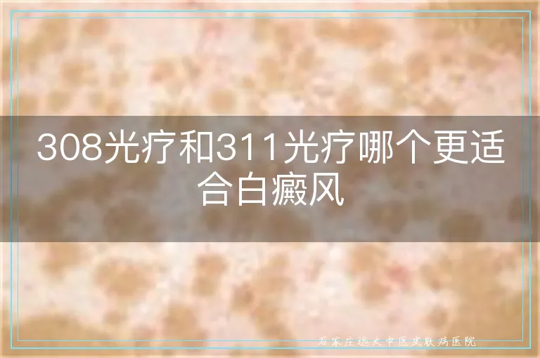 308光疗和311光疗哪个更适合白癜风