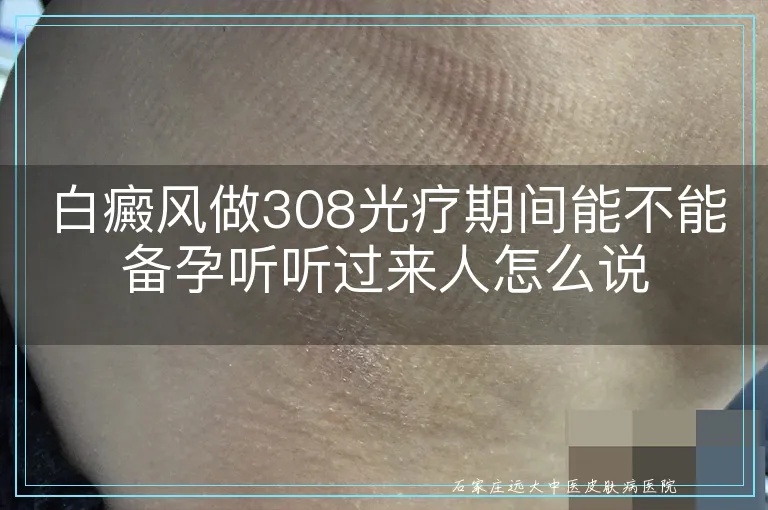 白癜风做308光疗期间能不能备孕听听过来人怎么说