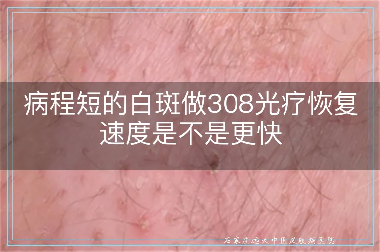 病程短的白斑做308光疗恢复速度是不是更快