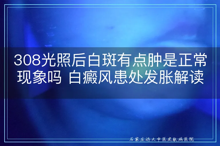 308光照后白斑有点肿是正常现象吗 白癜风患处发胀解读