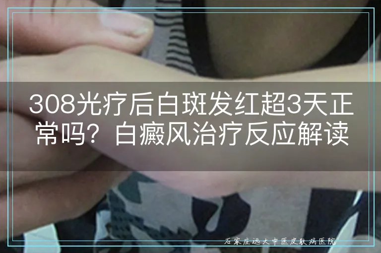 308光疗后白斑发红超3天正常吗?白癜风治疗反应解读