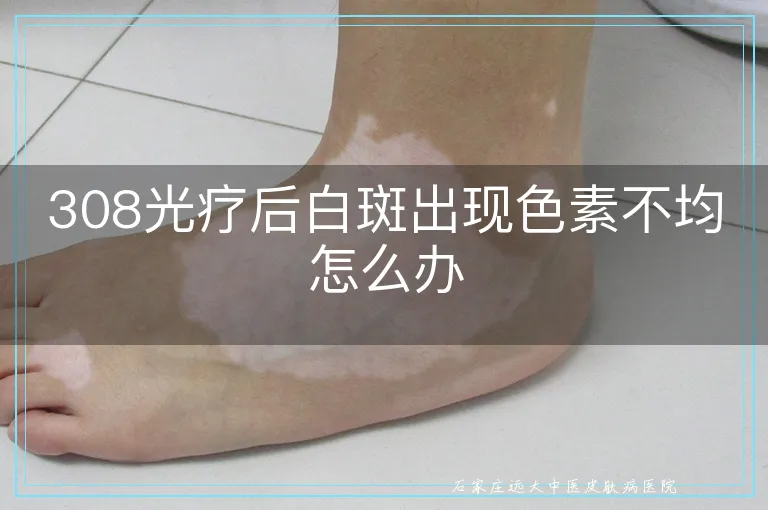 308光疗后白斑出现色素不均怎么办