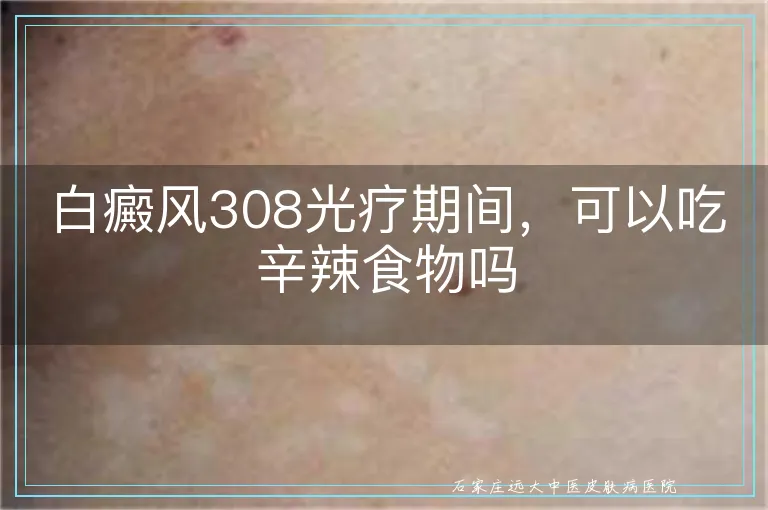 白癜风308光疗期间,可以吃辛辣食物吗