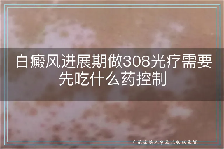 白癜风进展期做308光疗需要先吃什么药控制