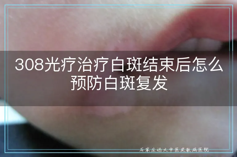 308光疗治疗白斑结束后怎么预防白斑复发