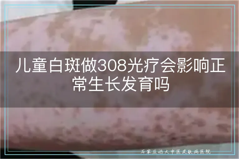 儿童白斑做308光疗会影响正常生长发育吗