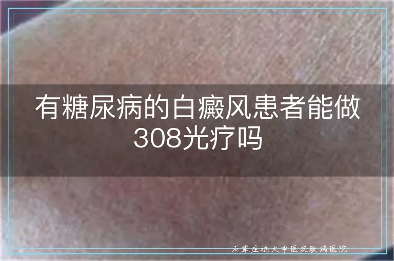 有糖尿病的白癜风患者能做308光疗吗