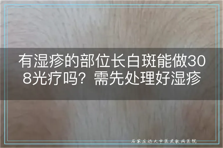 有湿疹的部位长白斑能做308光疗吗?需先处理好湿疹