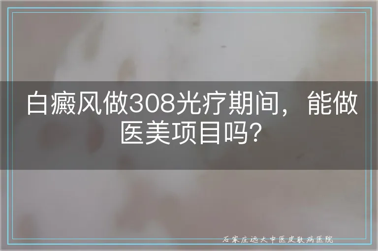 白癜风做308光疗期间，能做医美项目吗？
