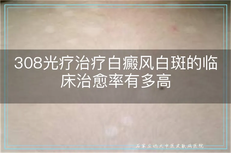 308光疗治疗白癜风白斑的临床治愈率有多高
