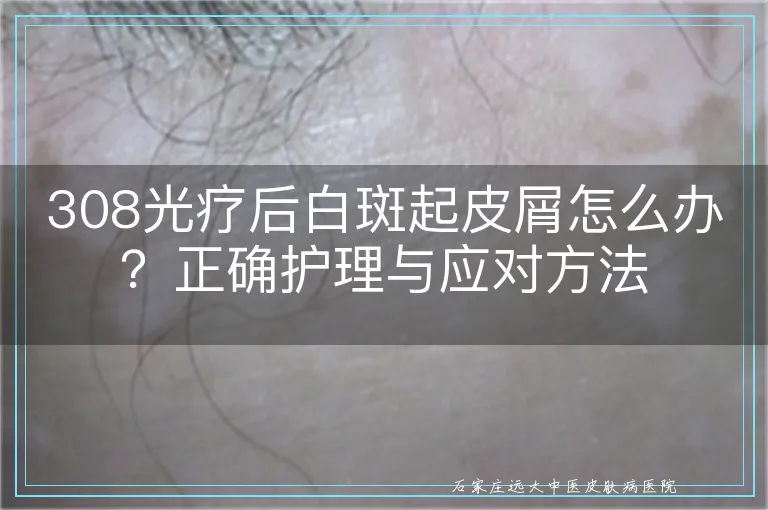 308光疗后白斑起皮屑怎么办？正确护理与应对方法