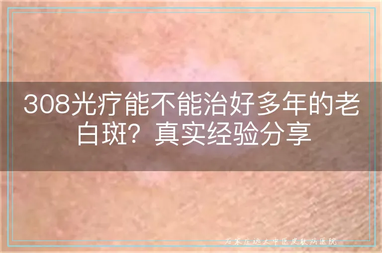 308光疗能不能治好多年的老白斑?真实经验分享