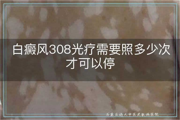 白癜风308光疗需要照多少次才可以停