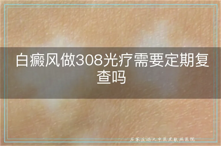 白癜风做308光疗需要定期复查吗