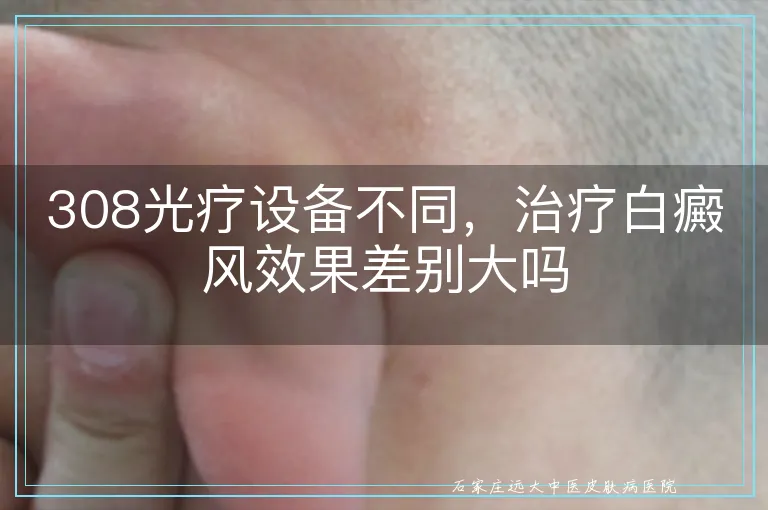 308光疗设备不同,治疗白癜风效果差别大吗