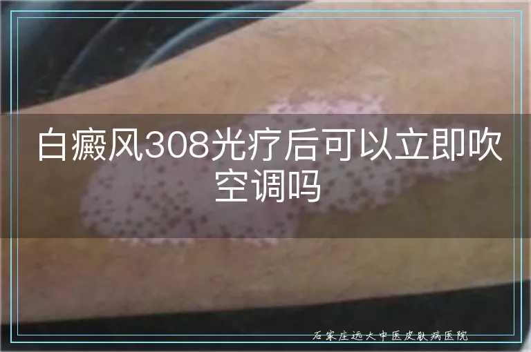 白癜风308光疗后可以立即吹空调吗