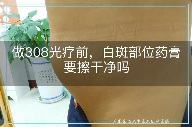 做308光疗前,白斑部位药膏要擦干净吗