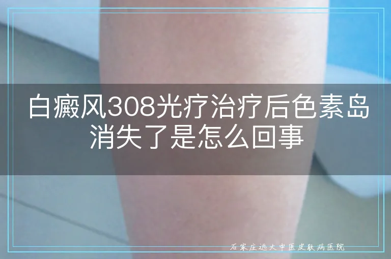 白癜风308光疗治疗后色素岛消失了是怎么回事