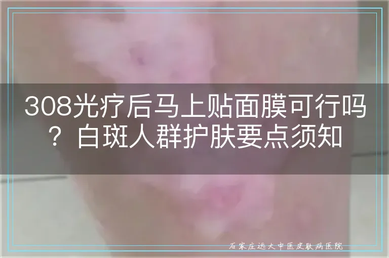 308光疗后马上贴面膜可行吗？白斑人群护肤要点须知