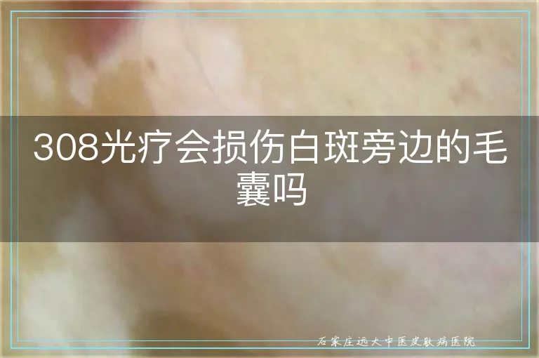 308光疗会损伤白斑旁边的毛囊吗
