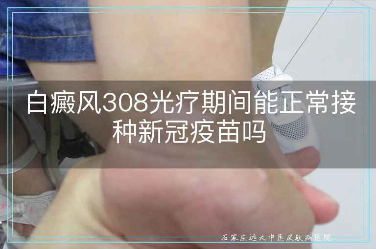 白癜风308光疗期间能正常接种新冠疫苗吗