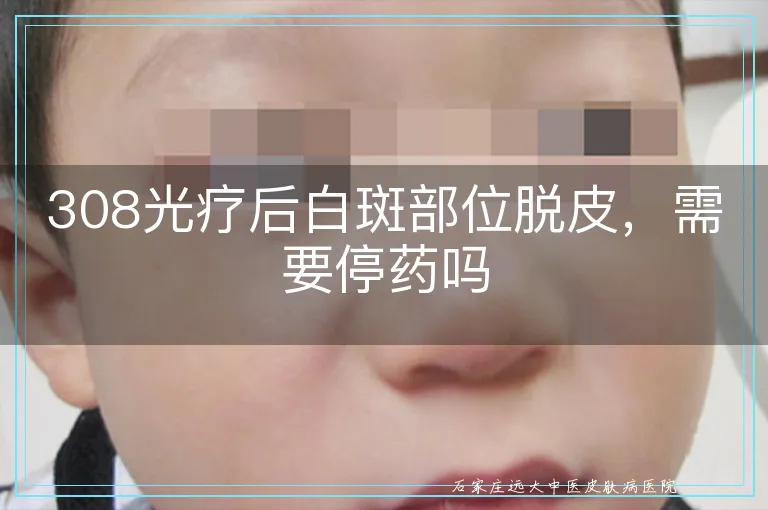308光疗后白斑部位脱皮,需要停药吗