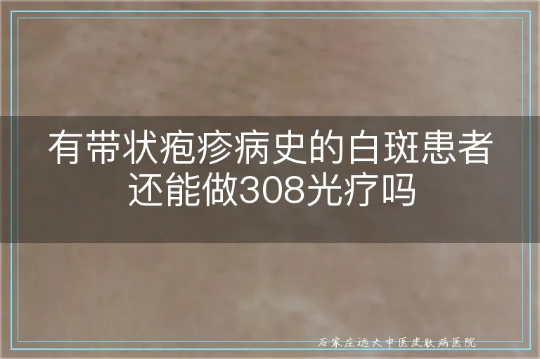 有带状疱疹病史的白斑患者还能做308光疗吗